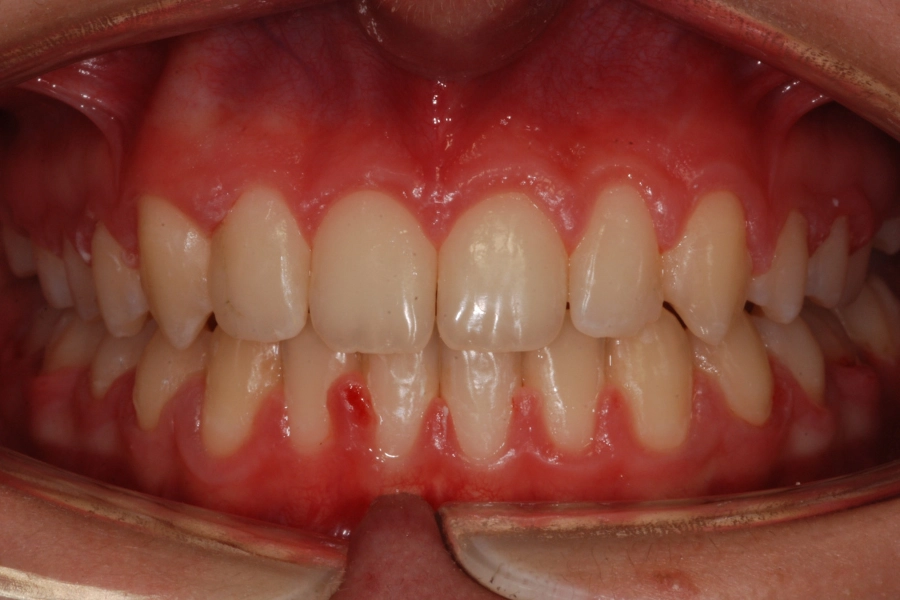 Denti sporgenti 1 dopo