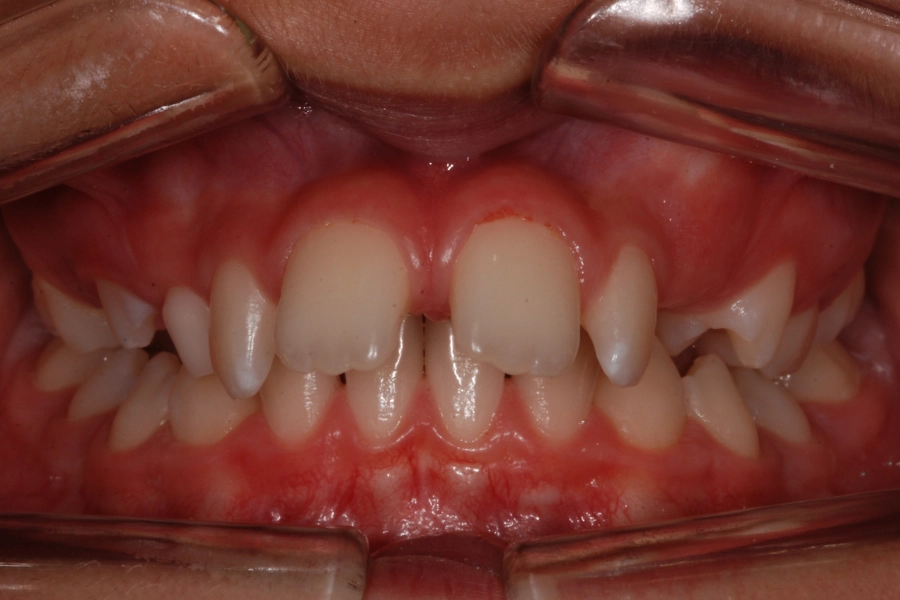 Denti sporgenti 1 prima