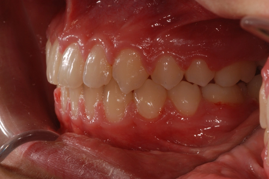 Denti sporgenti 2 dopo
